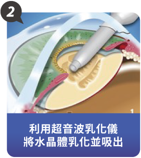 什麼是LEX全視清老花雷射