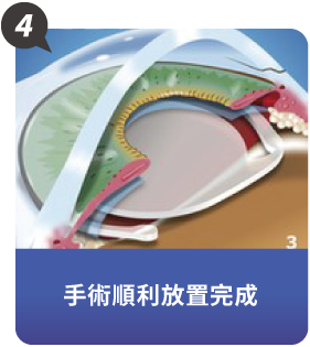 什麼是LEX全視清老花雷射